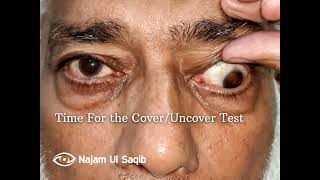 Partial Third Nerve Oculomotor Nerve Palsy With Pupillary Involvement [upl. by Inness]