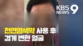 천연 염색약 ‘헤나’ 부작용…“가렵고 따갑고 검게 변했다”  KBS뉴스News [upl. by Aihsek4]