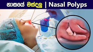 නාසයේ මස්දලු 😨 Nasal polyps and their treatment  How polypectomy is performed  in sinhala [upl. by Letnoj650]