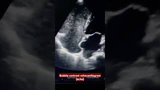 what is the diagnosis Bubble contrast echocardiogram echo [upl. by Notyarb305]