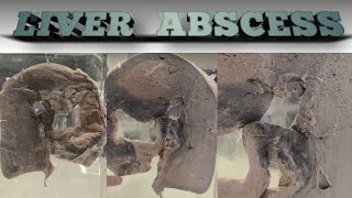 Liver abscess  pathology of liver  specimen of liver abscess [upl. by Attinahs318]