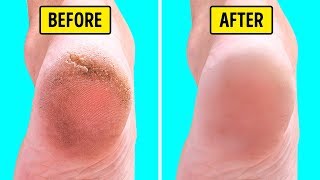 10 Natural Home Remedies for Silky Smooth Feet [upl. by Yendis]