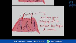 Why dental Crown Comes Out Failures in FPD Tooth preparation  Loss of Retention [upl. by Labana863]