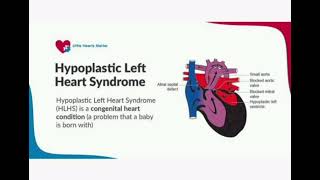 Hypoplastic left heart syndrome HLHS mrcpch Communication [upl. by Zoltai]