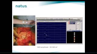 Natus IOM Webinar Brain Mapping Technique in IOM [upl. by O'Brien]