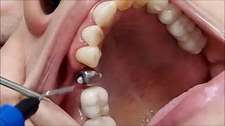 Impresión dental de arrastre de cofia funciona 100 de las veces [upl. by Attaymik122]