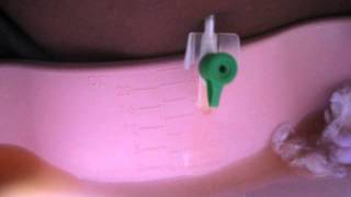 Drainage of Ascites using abdominal paracentesis [upl. by Iah]