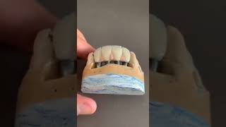 fixa de zirconia com coroa de emax [upl. by Kiyohara440]