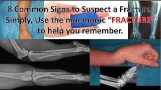 FRACTURE A Mnemonic Guide to Suspect a Fracture With Fraterne ZU medicalexcellencecenter [upl. by Anyek]