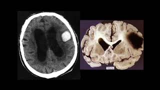 Imaging of intracranial hemorrhage [upl. by Enylhsa]