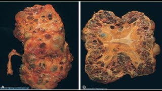 Pathology Urogenital Module  Congenital Anomalies [upl. by Ettegirb173]