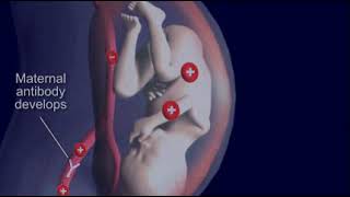 Jaundice Hemolytic Disease quotErythroblastosis fetalisquot in Newborn [upl. by Laddy197]