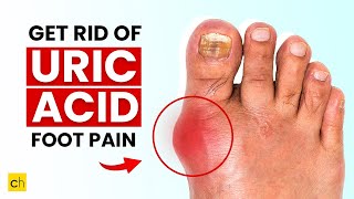 How do you get rid of URIC ACID PAIN in your foot  Must Know 7 Ways uricacid uricacid [upl. by Humpage570]