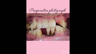 Preoperative and postoperative photographswith zirconia Bridge [upl. by Natiha882]