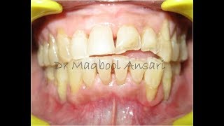 Non Surgical Periodontal Treatment case2 [upl. by Avah425]