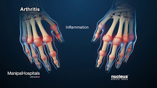 How Is Rheumatoid Arthritis Treated  Symptoms Of Rheumatoid Arthritis  Manipal Hospitals [upl. by Doniv]