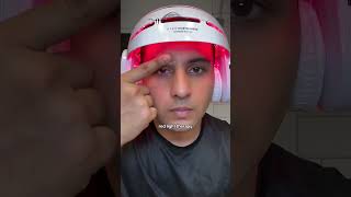 Day240 of Applying Minoxidil Restoring Hairline [upl. by Hachman]