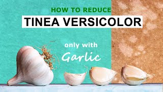 Treating Tinea Versicolor Part I [upl. by Einahc]