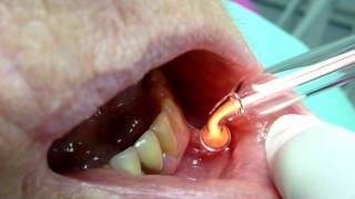 Canker Sores treatment Ozone DTA [upl. by Carvey]