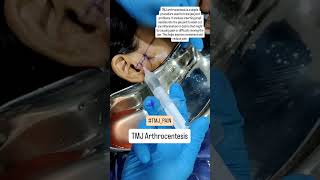 TMJ Arthrocentesis For TMJ Pain Relief  Dr Parit Ladani [upl. by Aspia]