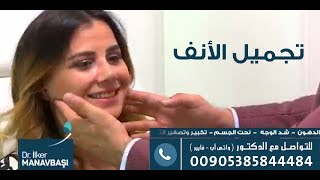 تجربة عملية تجميل الانف واصلاح انحراف الحاجز الانفي لسيدة  الدكتور اولكر مناف باشي 00905385844484 [upl. by Stromberg]