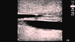 Transparent Ultrasound CVC Training Model [upl. by Ailaza]