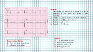 Hipertrofia ventricular derecha  Clases EKG 28 [upl. by Truelove369]