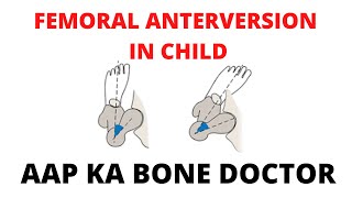 FEMORAL ANTEVERSION IN CHILD  EPISODE 55 [upl. by Laura]