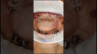 Multiunit healing cap removal for single piece MU implant for atrophic jaw rehabitation shorts [upl. by Broddy859]