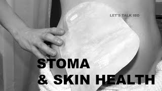 Stoma and Skin Health [upl. by Bevin378]