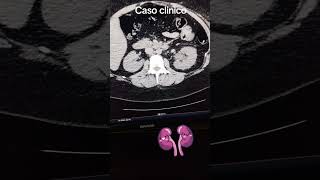 Caso clínico radiología  litiasis ureteral en unión ureterovesical  uropatia obstructiva [upl. by Akir]