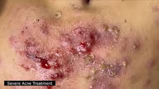 BEST BLACKHEAD AND WHITEHEAD REMOVAL SEVERE ACNE TREATMENT  SATISFYING AND RELAXING VIDEO [upl. by Coplin]