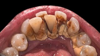 Crowding Teeth Will Increase Tartar Buildup  Scaling [upl. by Saval]