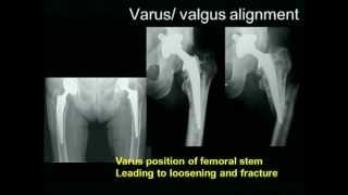 Biomechanics of the Hip Joint [upl. by Addiego]