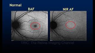 The Black amp White Fundus Images Red free Autofluorescence and Reflectance [upl. by Ardnasela24]