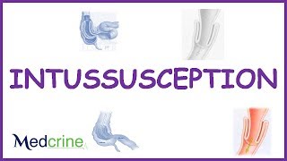 Intussusception  causes types  pathophysiologyfeaturesdx and treatment [upl. by Enomaj47]