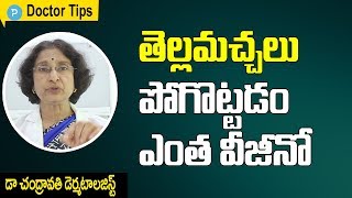 తెల్లమచ్చలు పోగొట్టడం ఎంత ఈజీనో  డెర్మాటోలజిస్ట్ డా చంద్రావతి చిట్కాలు Remove White Patches [upl. by Rhines]