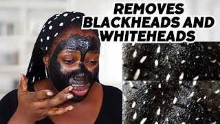 I TRIED DIY BLACKHEAD AND WHITEHEAD PEEL OFF MASK AND THIS HAPPENED [upl. by Mel]