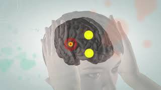 Animated video illustrating the pathophysiology of migraine [upl. by Ardnuyek415]