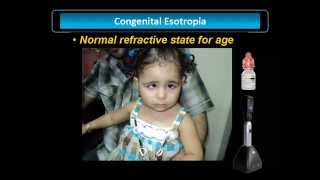 Congenital Esotropia [upl. by Yorgerg790]