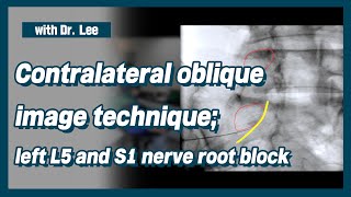 TrailerLearn contralateral oblique Carm image anatomy for L5 S1 nerve root block [upl. by Hasila577]