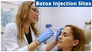 Botox Frontalis Glabella amp Nefertiti Treatment  Botox Injection Sites [upl. by Irod]