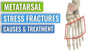 Metatarsal Stress Fractures  Causes Treatment Prevention [upl. by Tarttan]