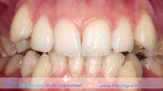 Elite Lingual Braces Study Club  Patient Morph Video [upl. by Nyleve]