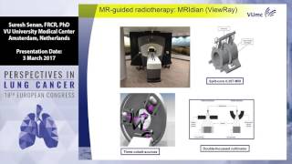 New radiotherapy techniques for the treatment of lung cancer [upl. by Nahtanhoj]