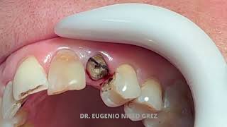 IMPRESION PARA CONDUCTO DENTAL [upl. by Nilloc]