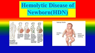 HEMOLYTIC DISEASE OF NEWBORN HDN [upl. by Kopp692]