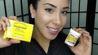 Clear Acne FAST Using Sulfur  â™¥ [upl. by Kerr]