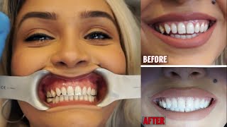 I GOT MY TEETH WHITENED FOR THE FIRST TIME  WELLWOOD DENTISTRY part 1 [upl. by Annoya]