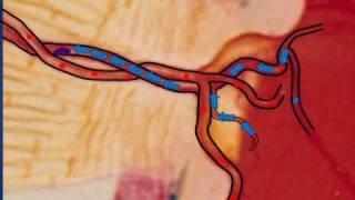 What is Central Retinal Vein Occlusion CRVO [upl. by Allyn]